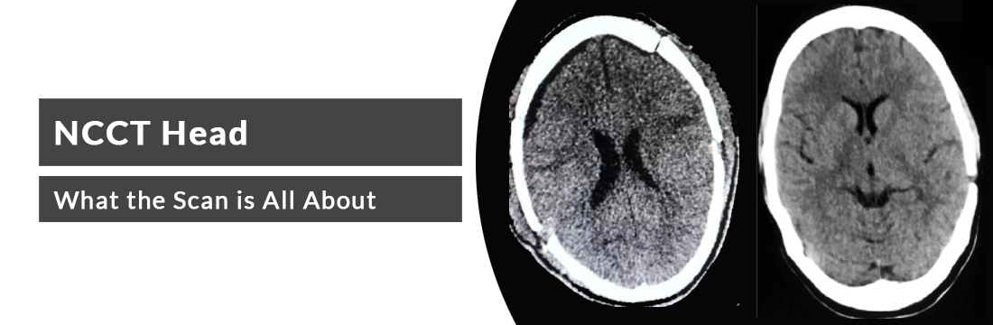 NCCT Head: What the Scan is All About